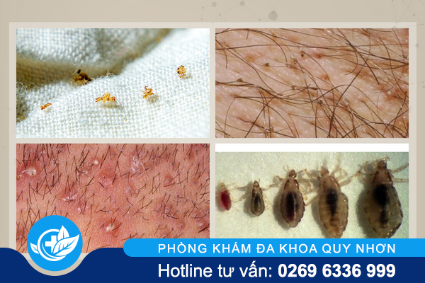 ran-mu-la-benh-gi-nguyen-nhan-dau-hieu-va-cach-chua-2