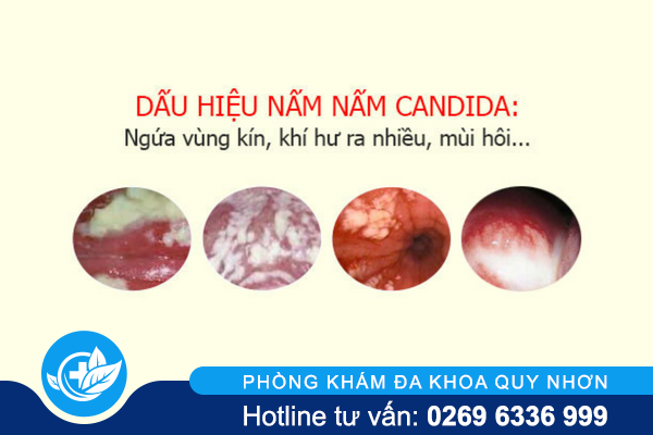 nam-candida-nguyen-nhan-trieu-chung-va-khac-phuc-hieu-qua-1