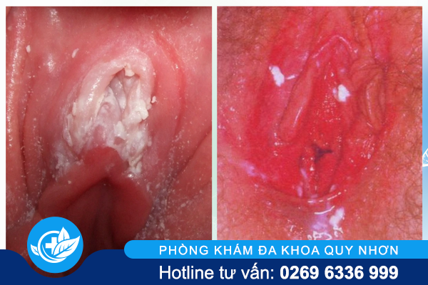 nam-vung-kin-la-gi-va-khac-phuc-the-nao-1