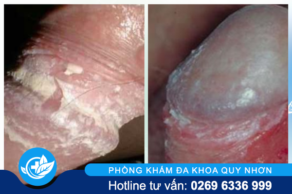 nam-vung-kin-la-gi-va-khac-phuc-the-nao-2