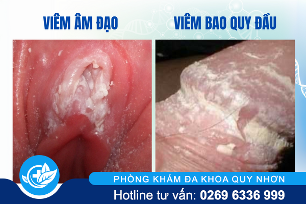 nam-vung-kin-la-gi-va-khac-phuc-the-nao-3