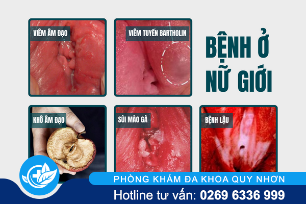 sung-vung-kin-benh-gi-va-khac-phuc-the-nao-hieu-qua-1