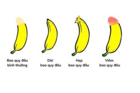 Điểm danh những bệnh thường gặp ở bao quy đầu