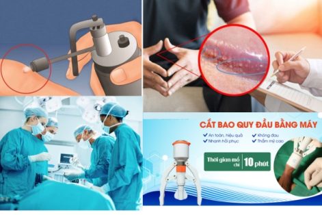 Cách chữa hạt ngọc dương vật hiệu quả an toàn cho nam giới