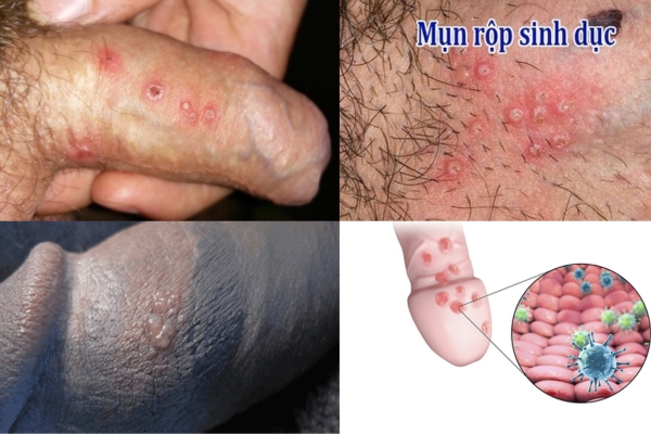 noi-mun-bao-quy-dau-nguyen-nhan