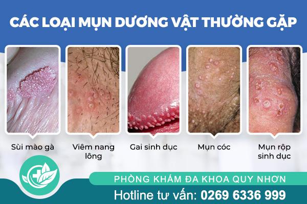 cac-loai-mun-duong-vat-thuong-gap