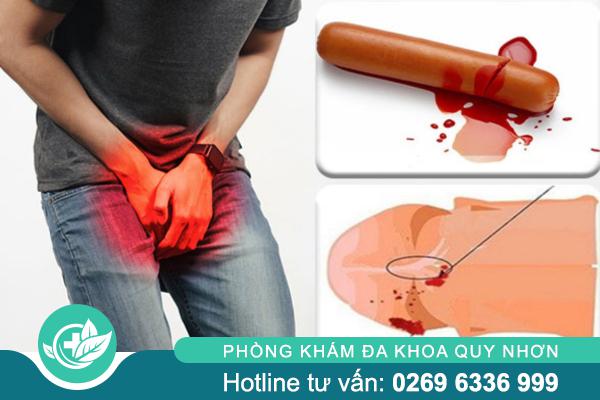Dương vật chảy máu – Cảnh báo nhiều bệnh lý nam khoa tiềm ẩn