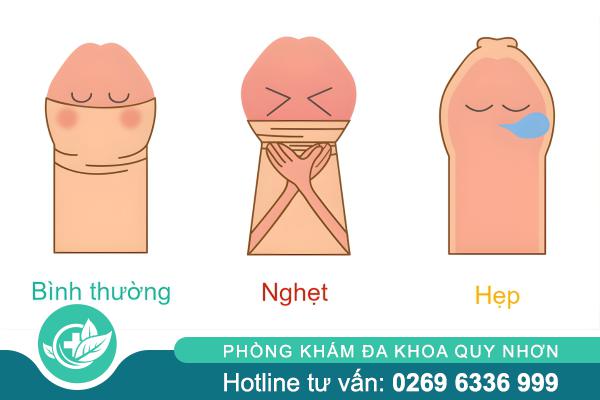 Cảnh báo: Hẹp bao quy đầu có thể gây nhiều hệ lụy