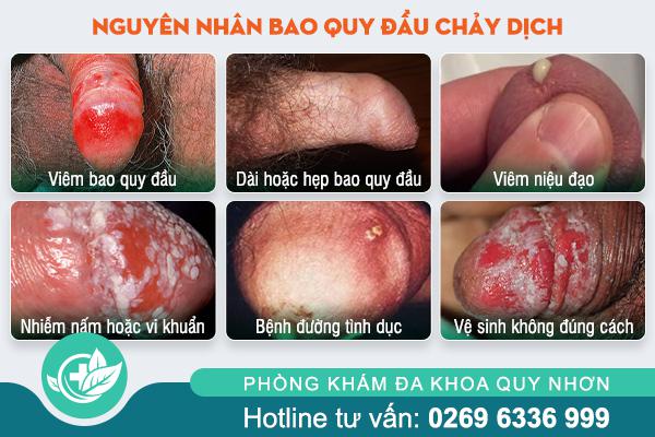 nguyen-nhan-bao-quy-dau-chay-dich