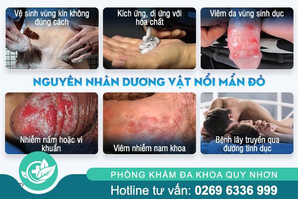 nguyen-nhan-duong-vat-noi-man-do