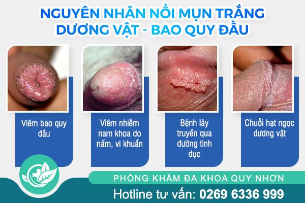 nguyen-nhan-noi-mun-trang-duong-vat-bao-quy-dau