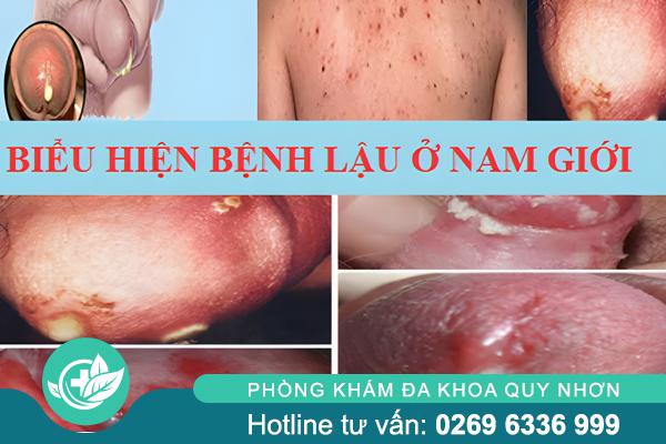 bieu-hien-benh-lau-nam