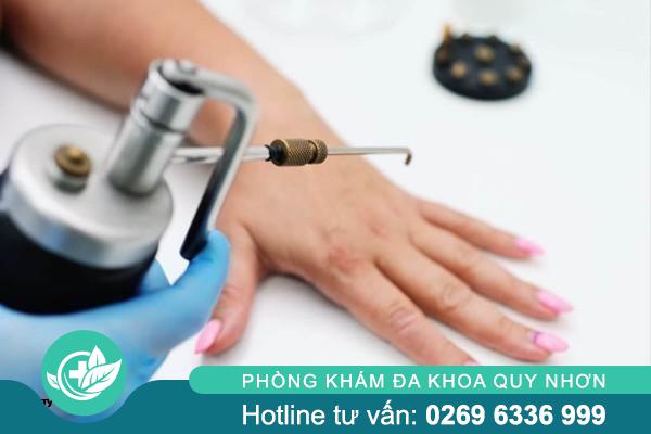 Đốt sùi mào gà có hiệu quả không? Bác sĩ giải đáp