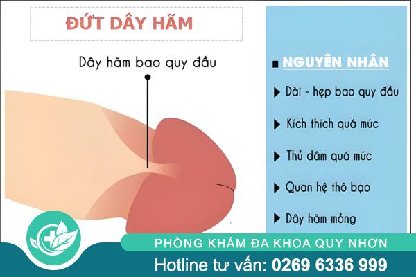 Đứt dây hãm bao quy đầu và những rủi ro nam giới cần biết