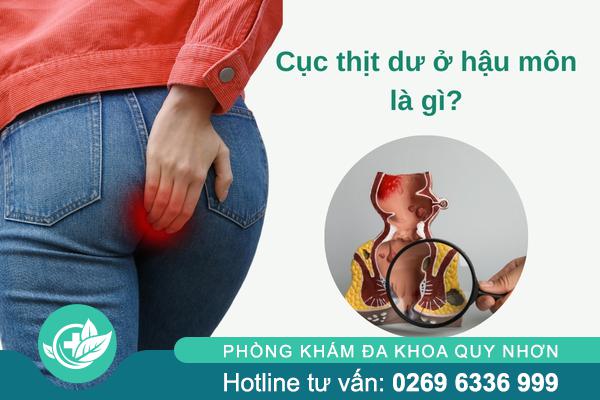 Cục thịt dư ở hậu môn: Dấu hiệu bệnh lý không nên chủ quan