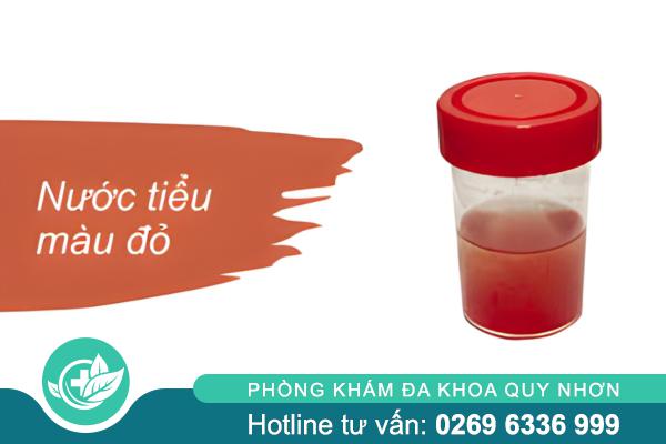 Nước tiểu màu đỏ – Dấu hiệu bất thường của cơ thể