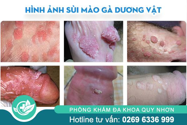 sui-mao-ga-duong-vat