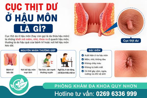 Cục thịt dư ở hậu môn: Dấu hiệu bệnh lý không nên chủ quan