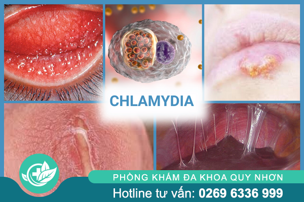 thong-tin-nen-biet-ve-benh-xa-hoi-o-nam-va-nu-4-1