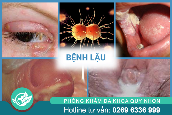 thong-tin-nen-biet-ve-benh-xa-hoi-o-nam-va-nu-5-1