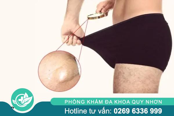 Mối liên hệ giữa nổi hạch vùng kín và các bệnh lây truyền qua đường tình dục