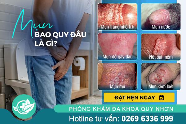 mun-bao-quy-dau-la-gi