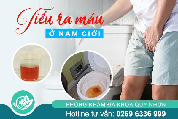 Tiểu ra máu bất thường – Khi nào cần đi khám ngay?