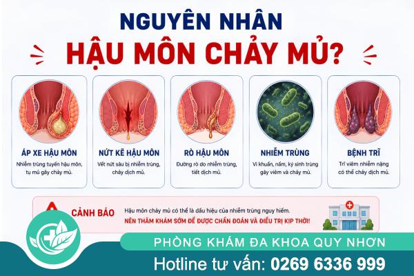 Vì Sao Hậu Môn Chảy Mủ? Nguyên Nhân Và Cách Khắc Phục