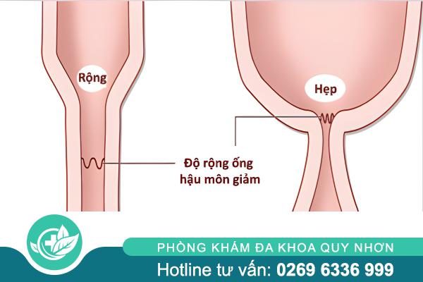 Hẹp hậu môn: Dấu hiệu nhận biết và phương pháp chữa trị hiệu quả