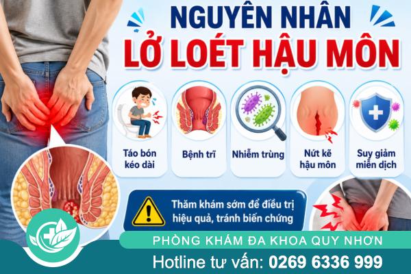 Đừng Chủ Quan Khi Bị Lở Loét Hậu Môn