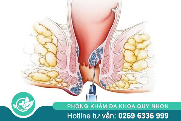 Tiêm xơ búi trĩ có hiệu quả không? Giải đáp từ bác sĩ