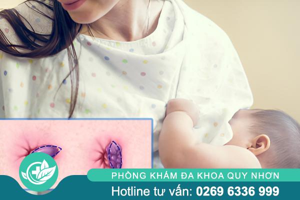 Cảnh Báo: Bệnh Trĩ Sau Sinh Có Thể Gây Biến Chứng Nguy Hiểm